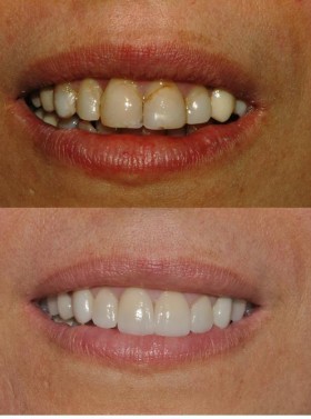 Come riconoscere un dentista estetico - Faccette Dentali Estetiche
