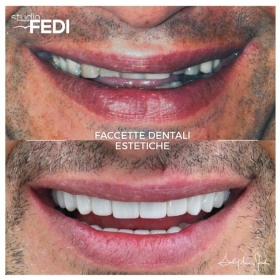 10 faccette dentali estetiche in ceramica con rialzo della occlusione - Faccette Dentali Estetiche