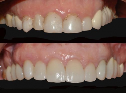 Odontoiatria estetica e odontoiatra estetico - Faccette Dentali Estetiche