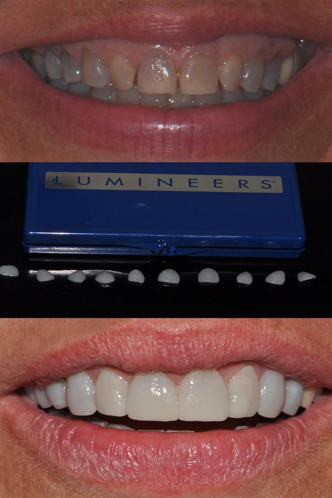 Lumineers. Faccette in ceramica per un caso di denti scuri per discromia grave - Faccette Dentali Estetiche